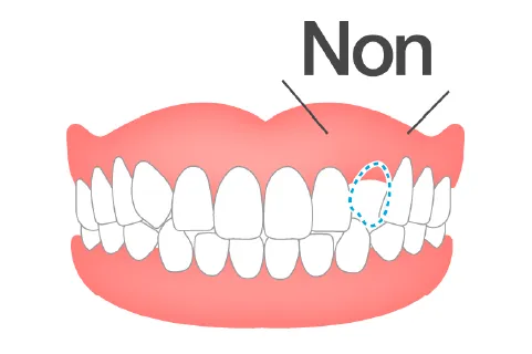 歯が足りない・生えてこないケース