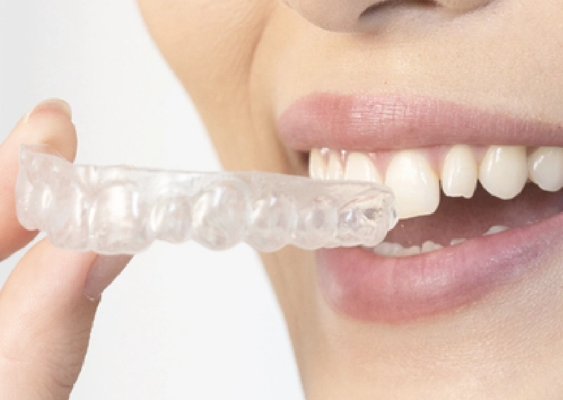 マウスピース矯正