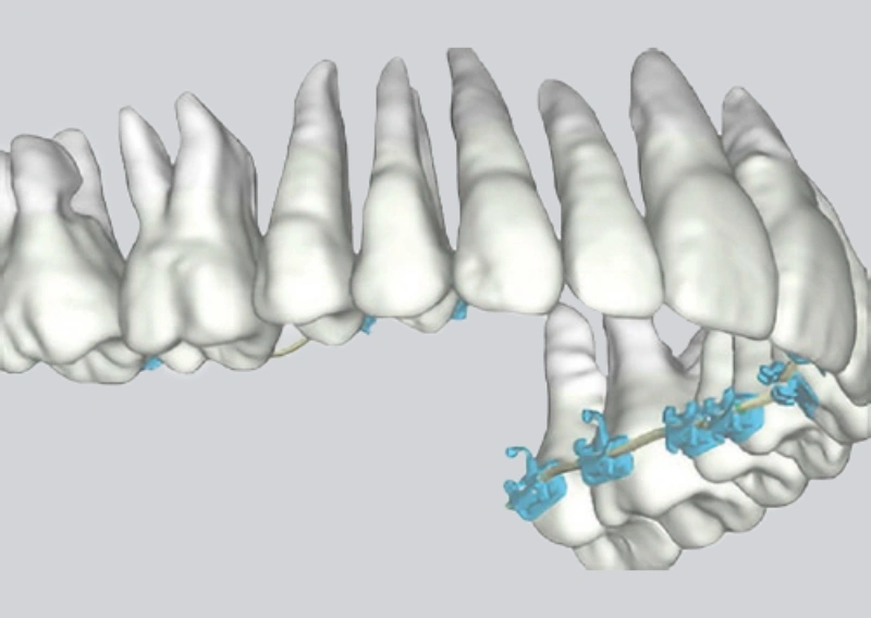 デジタル技術を活用した矯正治療