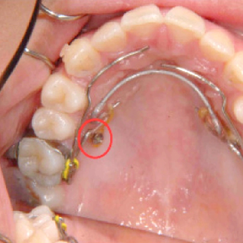 歯科矯正用アンカースクリュー
