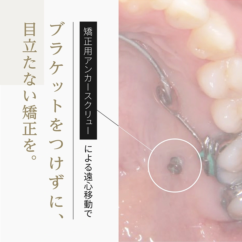 矯正用アンカースクリューによる遠心移動でブラケットをつけずに。Ⅰ期治療で。｜さわだ矯正歯科クリニック