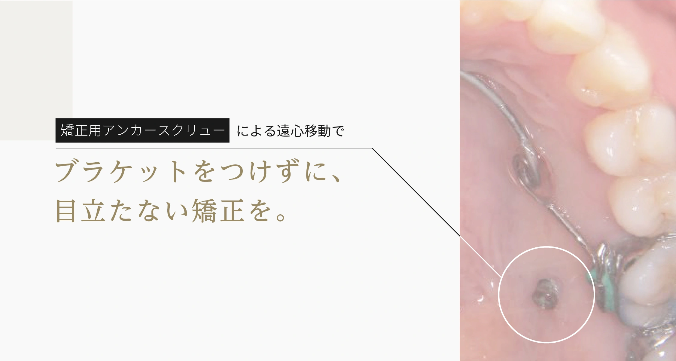 矯正用アンカースクリューによる遠心移動でブラケットをつけずに。Ⅰ期治療で。｜さわだ矯正歯科クリニック