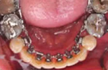 周りに矯正治療を気付かれない！