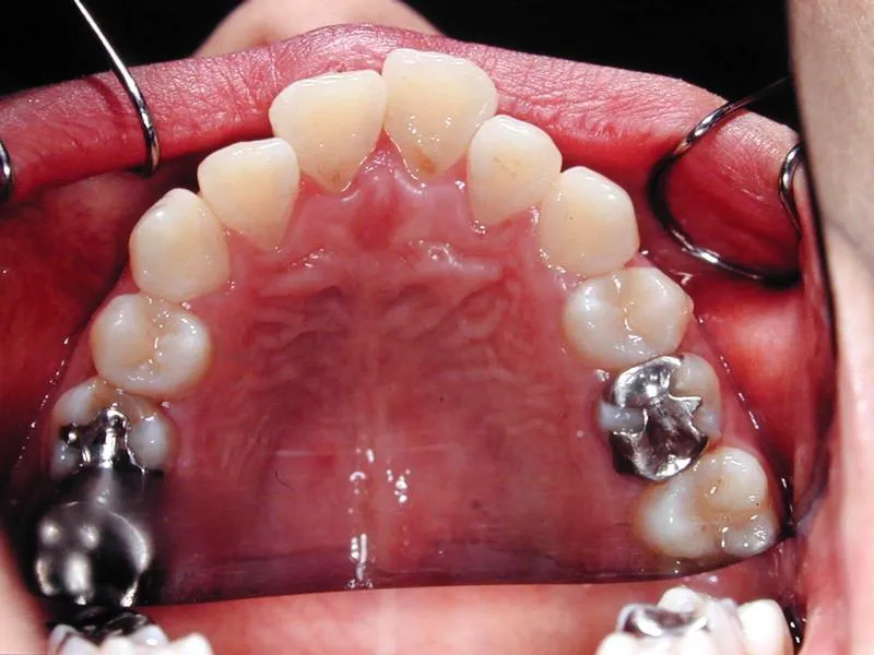 上顎前突/成人/歯を抜く治療,施術前