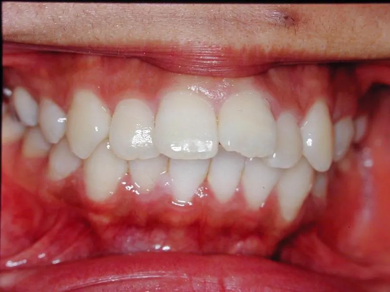 上顎前突/成人/歯を抜く治療,施術前