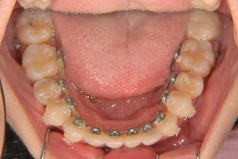 上顎前突・叢生/成人,矯正器具