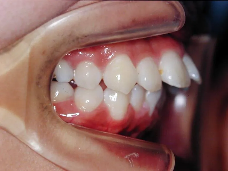 上顎前突/成人/歯を抜く治療,施術前