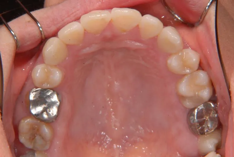 上顎前突/成人/歯を抜く治療,施術後