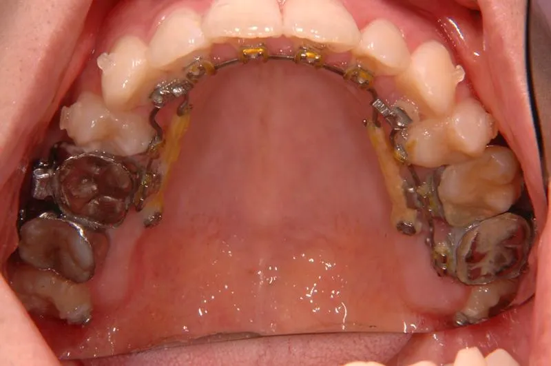 上顎前突/成人/歯を抜く治療,矯正器具