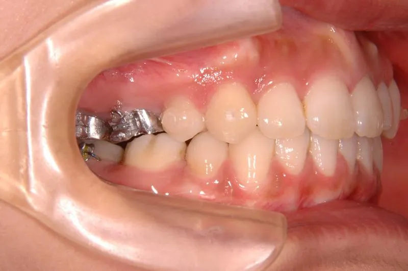 上顎前突/成人/歯を抜く治療,矯正器具