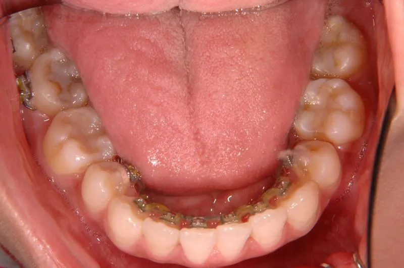 上顎前突/成人/歯を抜く治療,矯正器具