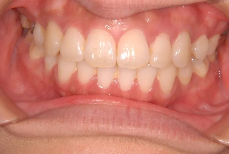 上顎前突/成人/歯を抜く治療,施術後