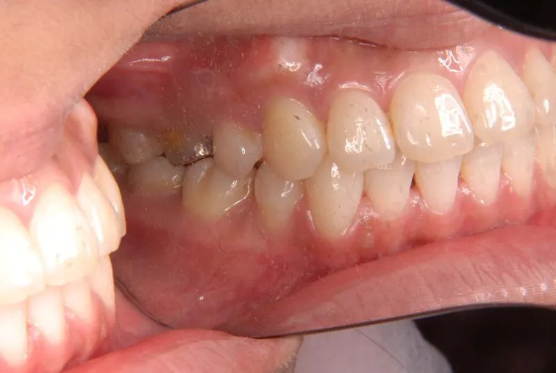 上顎前突/成人/歯を抜く治療,施術後