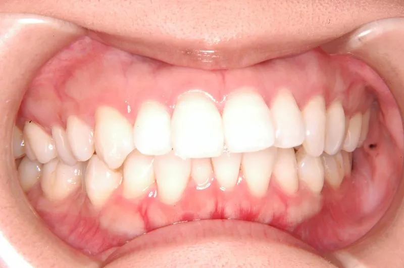 上顎前突・叢生/成人,施術前