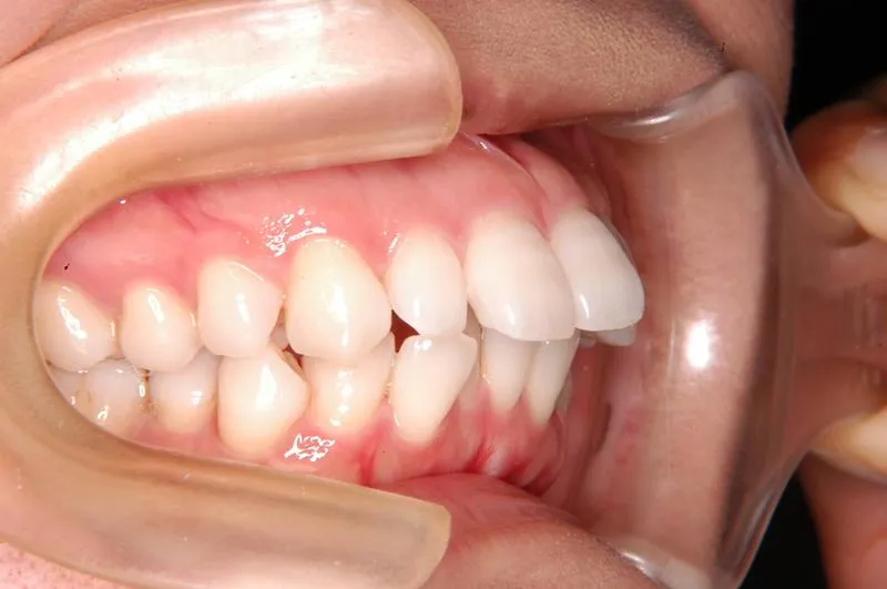 上顎前突・叢生/成人,施術前