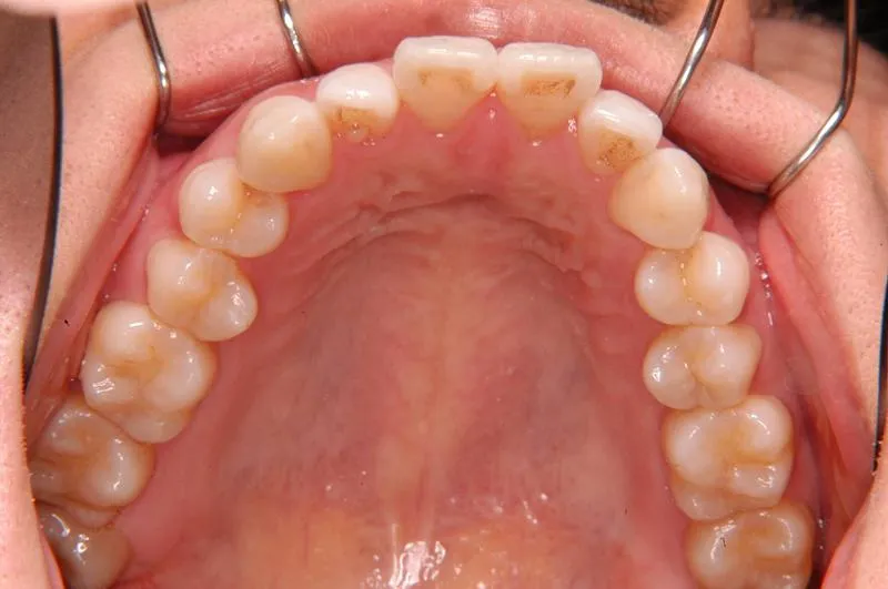 上顎前突・叢生/成人,施術前