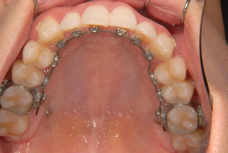 上顎前突・叢生/成人,矯正器具