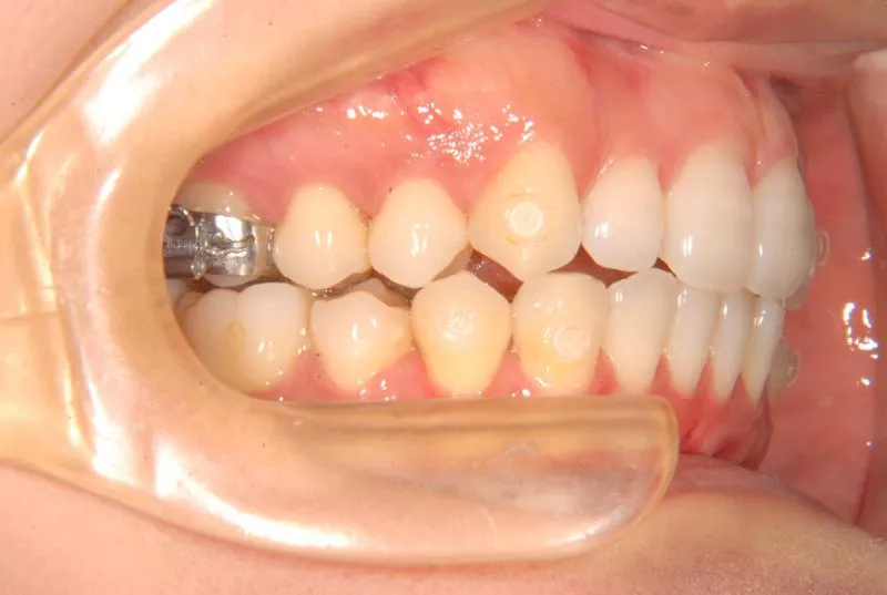 上顎前突・叢生/成人,矯正器具