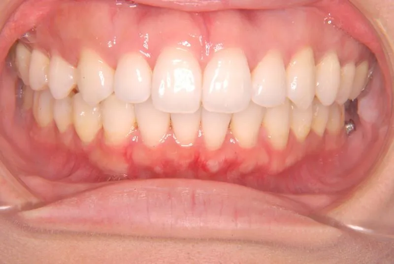 上顎前突・叢生/成人,施術後