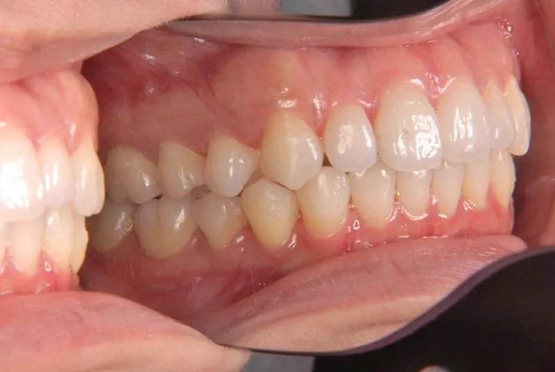 上顎前突・叢生/成人,施術後