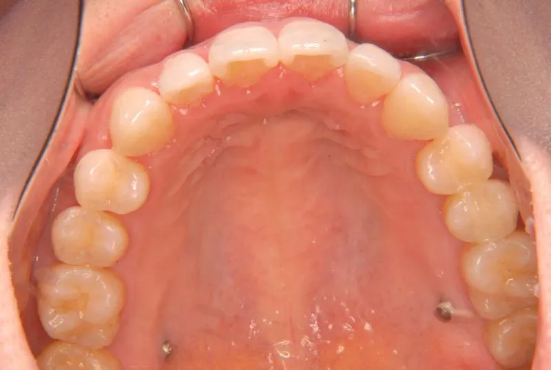 上顎前突・叢生/成人,施術後