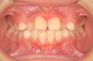 【子供の矯正（一期）】切端咬合・永久歯が生える隙間がない・非抜歯症例・8歳男子【K.Y様】