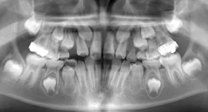 【子供の矯正（一期）】埋伏歯・受け口・永久歯が生える隙間がない・非抜歯症例・9歳女子【K.T様】