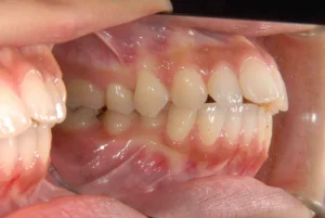 【大人の矯正】口ゴボ・口元が出ている・非抜歯症例・30歳女性【H.H様】