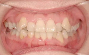 【大人の矯正】ガタガタ・八重歯・非抜歯症例・41歳女性【S.I様】