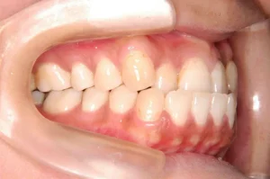 【大人の矯正】受け口・八重歯・ガタガタ・非抜歯症例・33歳女性【M.Y様】