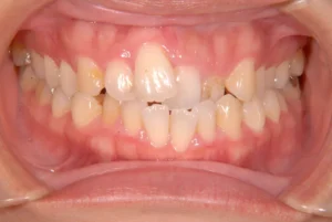 【大人の矯正】ガタガタ・前歯がずれている・非抜歯症例・33歳女性【M.F様】