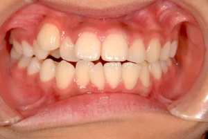 八重歯・噛めない・14歳女性【M.T様】