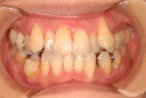 【大人の矯正】がたがた・八重歯・内側から歯が生えている・非抜歯症例・40歳女性【S.H様】
