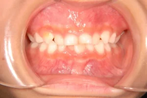 叢生・早期治療・6歳女児【S.T様】