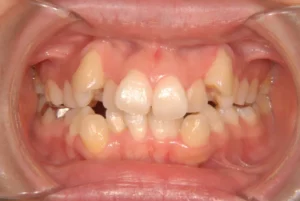 八重歯・ガタガタ・癒合歯・ピエゾサージェリー・26歳女性【M.H様】