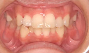 出っ歯・がたがた・30歳女性【M.S様】