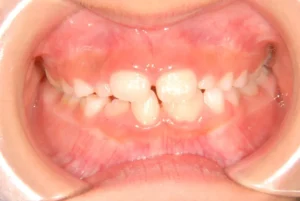 癒合歯・永久歯が生えるスペースがない・7歳男児【K.F様】