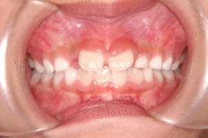 前歯がハの字に生えている・7歳女児【M.M様】