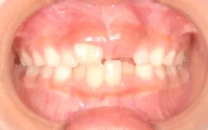 永久歯の生えるスペースがない・ガタガタ・7歳女児【M.K様】