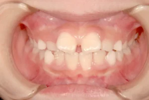 【子供の矯正（一期）】すきっ歯・前歯がねじれている・9歳女児【M.K様】