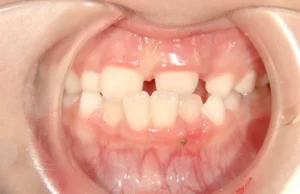 【子供の矯正（一期）】すきっ歯・永久歯が生える隙間がない・反対咬合・7歳男児【K.S様】