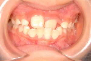 反対咬合・ガタガタ・過剰歯・7歳女児【R.K様】