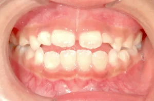 前歯で噛めない・舌癖・7歳女児【M.O様】