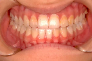 顎変形症・受け口・顎のゆがみ・18歳女性【Y.F様】