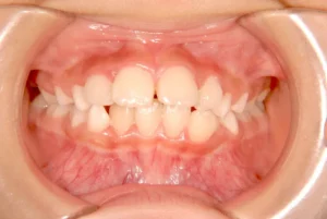 出っ歯・前歯がゆがんでいる・8才女児【H.M様】