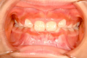 噛み合わせが深い・下の歯が見えない・8歳女児【K.F様】