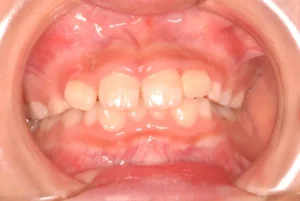 前歯がゆがんでいる・ガタガタ・8歳男児【S.N様】