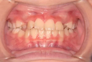 前歯がゆがんでいる・犬歯の生える隙間がない・9歳女児【M.O】