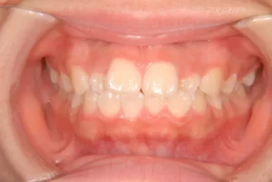 【大人の矯正】ガタガタ・口元が出ている・15歳女性【M.S様】