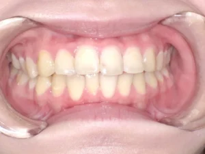 上下がガタガタ・出っ歯・20歳女性【N.K様】